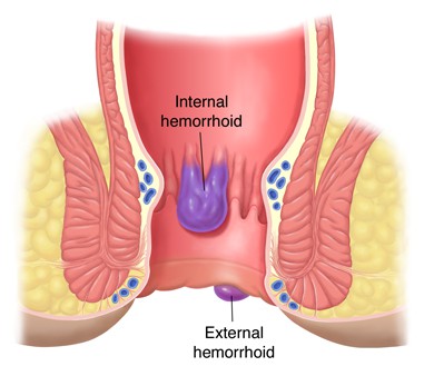  what causes hemorrhoids