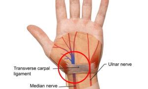 Carpal Tunnel Home Remedies